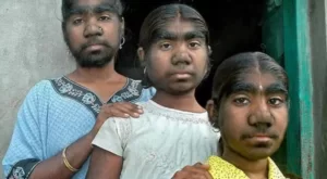 Sindrome-do-Lobisomem-entre-as-doencas-raras-e-exoticas.webp